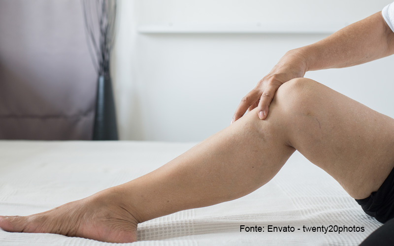 Varizes nas pernas: sintomas, causas e tratamentos
